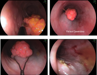 Papilloma Squamoso Dellesofago Endoscopiadigestiva It Di Felice