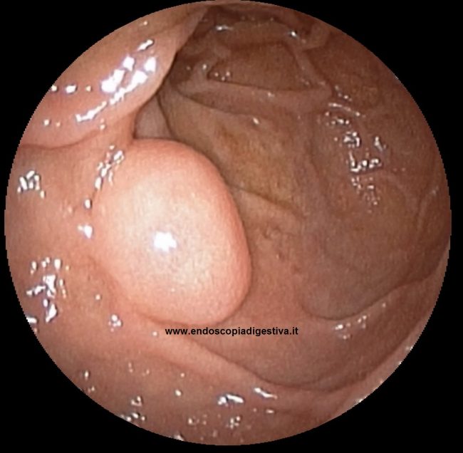 Duodeno Endoscopiadigestiva It Di Felice Cosentino Per Parlare Di